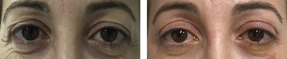 Blefaroplastia Superior